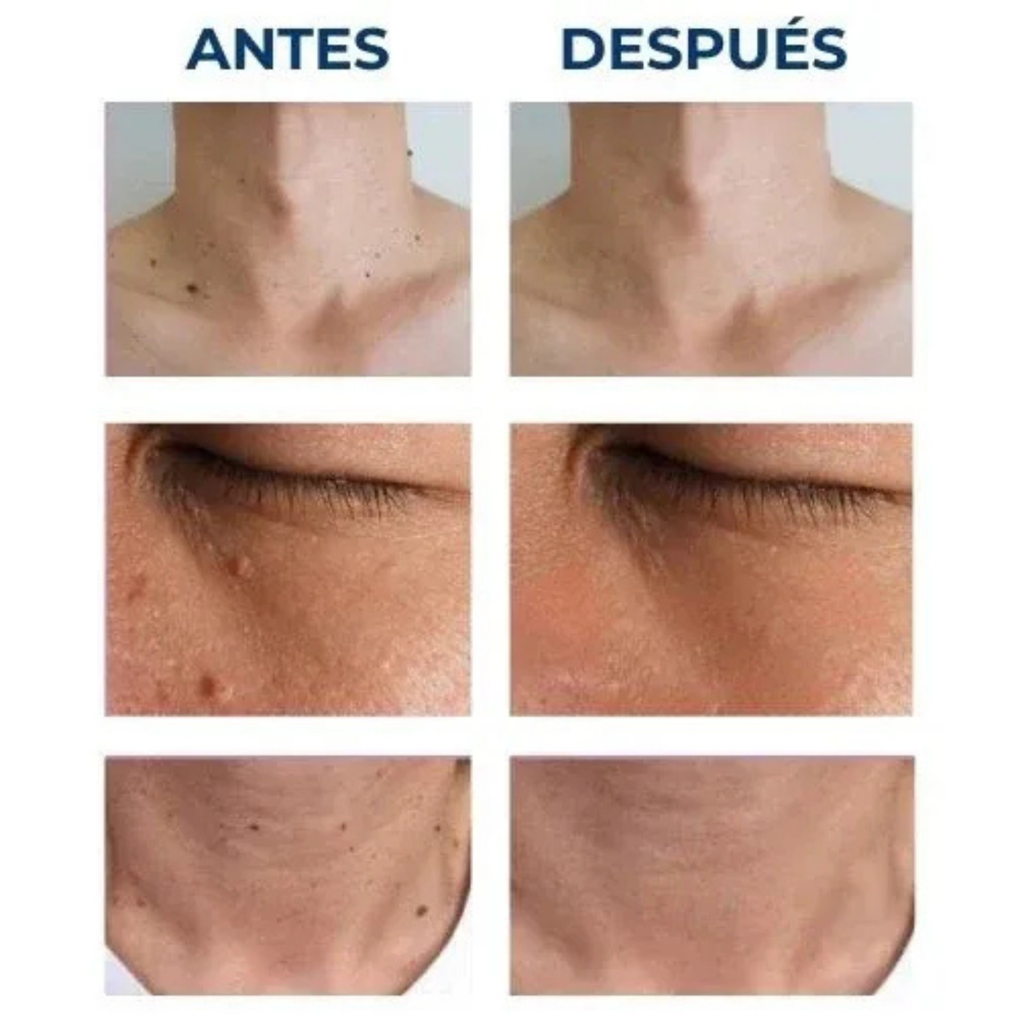 Luminiix Eliminador de Verrugas – Fórmula Natural sin Dolor y sin Cicatrices