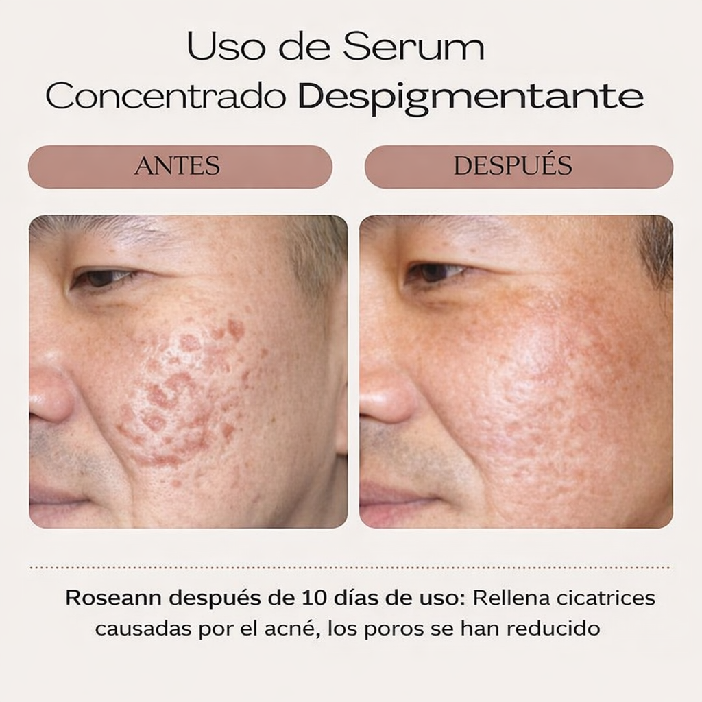 SERUM CONCENTRADO DESPIGMENTANTE  - Fórmula profesional para piel más uniforme