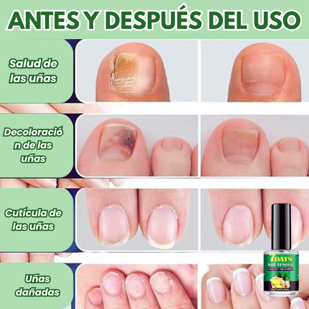 Tratamiento para los hongos de las uñas