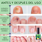Tratamiento para los hongos de las uñas