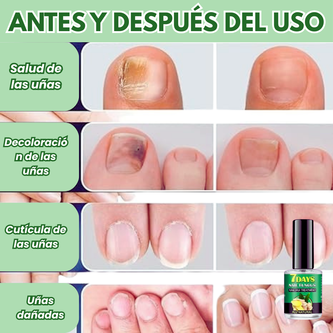 Tratamiento para los hongos de las uñas