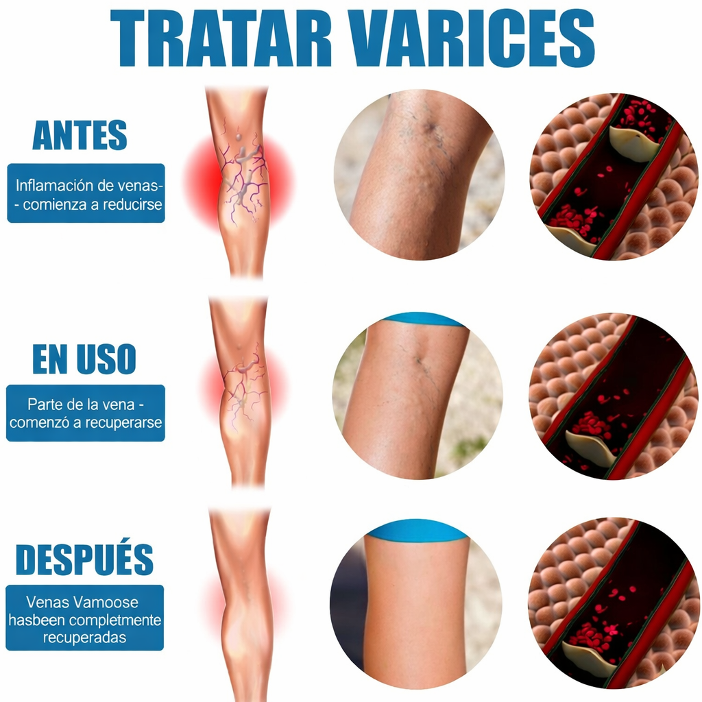 Spray para el alivio de las varices: fórmula natural de rápida absorción para la hinchazón, el dolor y el cansancio de las piernas.