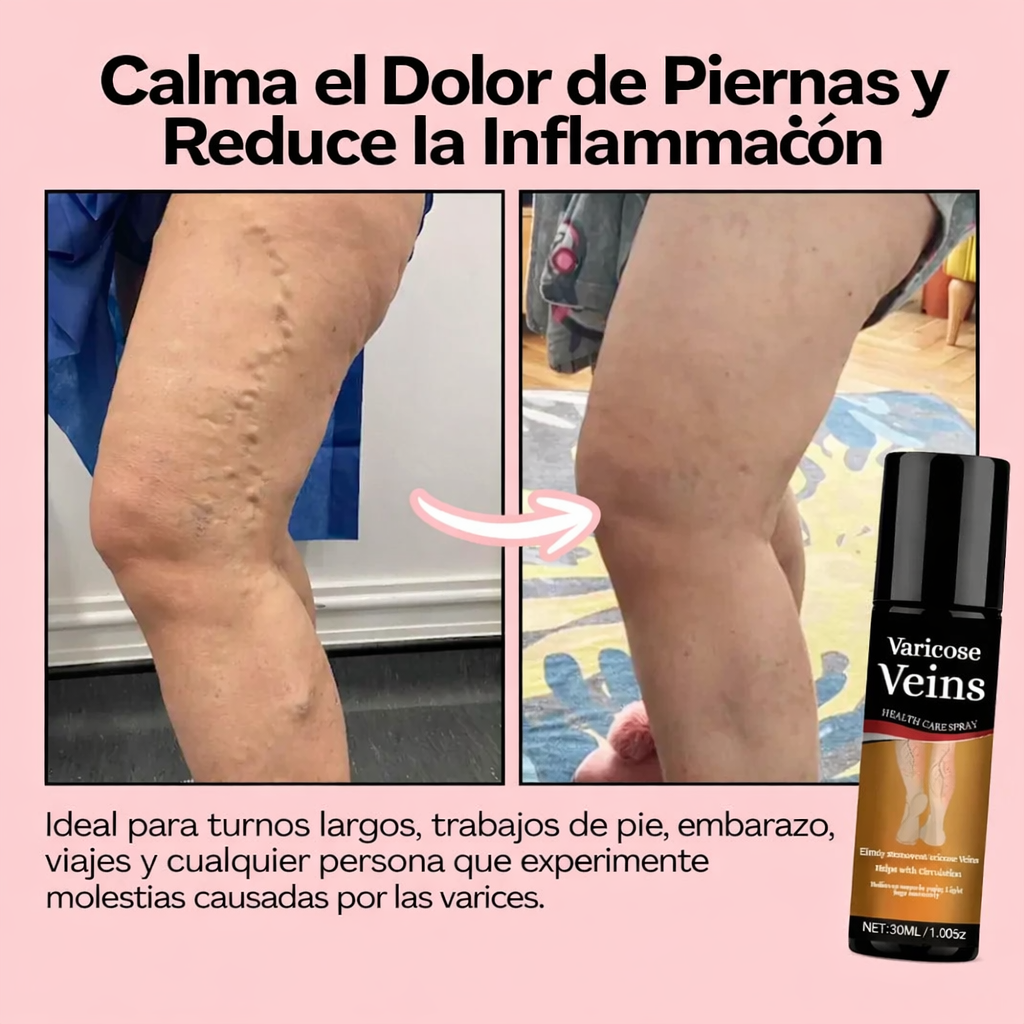 Spray para el alivio de las varices: fórmula natural de rápida absorción para la hinchazón, el dolor y el cansancio de las piernas.