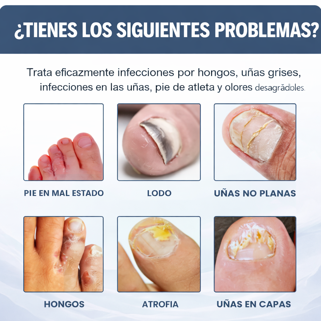 Spray para Uñas Grises - Cuidado efectivo antifúngico para uñas y pies