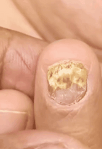 Tratamiento para los hongos de las uñas