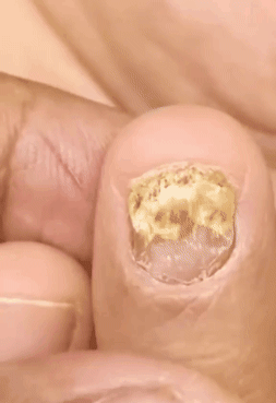 Tratamiento para los hongos de las uñas