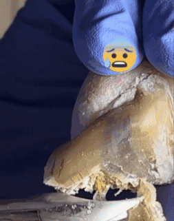 Tratamiento para los hongos de las uñas